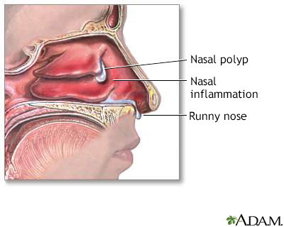Nasal polyps - Illustration Thumbnail                      