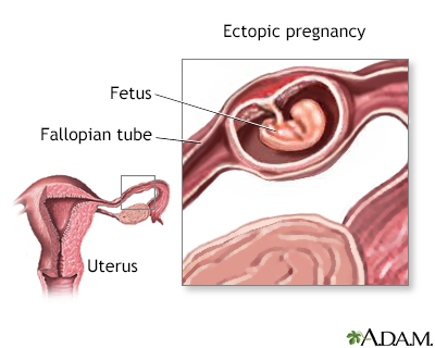 Ectopic pregnancy - Illustration Thumbnail                      