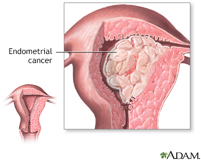 Endometrial cancer - Illustration Thumbnail                      