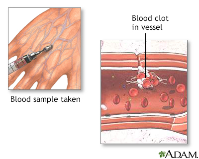 Blood clots - Illustration Thumbnail                      