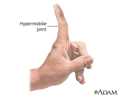 Hypermobile joints - Illustration Thumbnail                      
