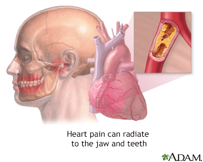 Jaw pain and heart attacks - Illustration Thumbnail                      