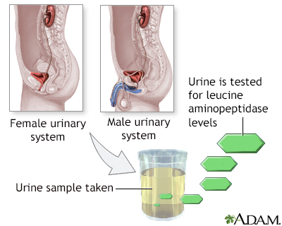 Leucine aminopeptidase urine test - Illustration Thumbnail                      
