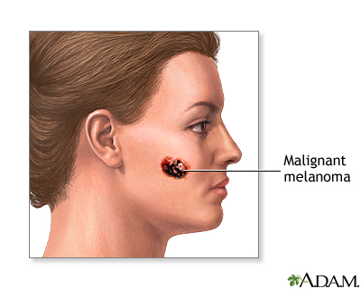 Malignant melanoma - Illustration Thumbnail                      