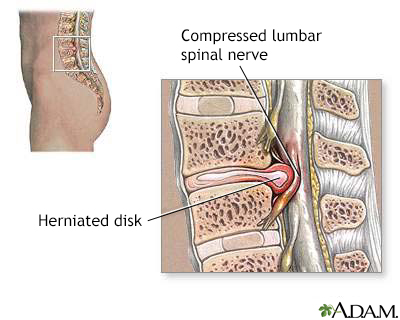 Herniated lumbar disk - Illustration Thumbnail                      