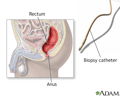 Rectal biopsy - Illustration Thumbnail                      