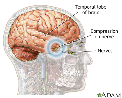 Brain hernia - Illustration Thumbnail                      