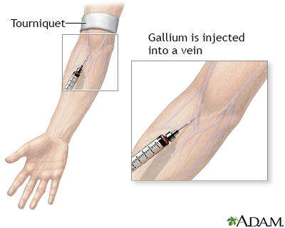 Gallium injection - Illustration Thumbnail                      