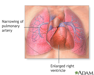Primary pulmonary hypertension - Illustration Thumbnail                      