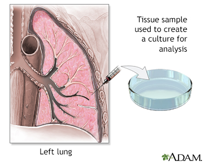 Lung tissue biopsy - Illustration Thumbnail                      