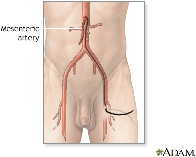 Mesenteric arteriography - Illustration Thumbnail                      