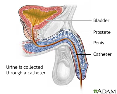 Catheterization - Illustration Thumbnail                      