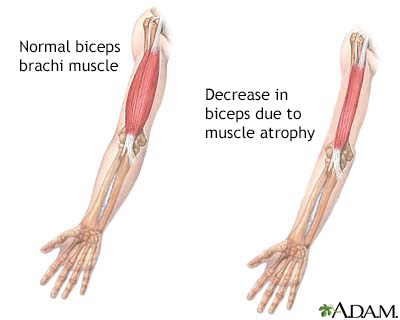 Muscular atrophy - Illustration Thumbnail                      