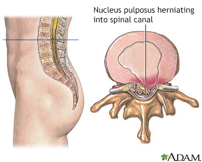 Herniated nucleus pulposus - Illustration Thumbnail                      