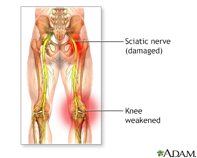 Sciatic nerve damage - Illustration Thumbnail                      