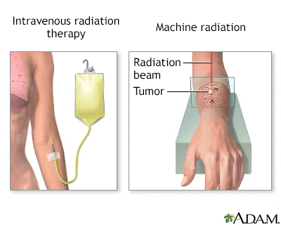 Radiation therapy - Illustration Thumbnail                      