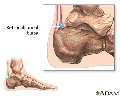 Retrocalcaneal bursitis - Illustration Thumbnail                      