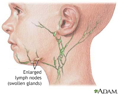 Swollen lymph node - Illustration Thumbnail                      