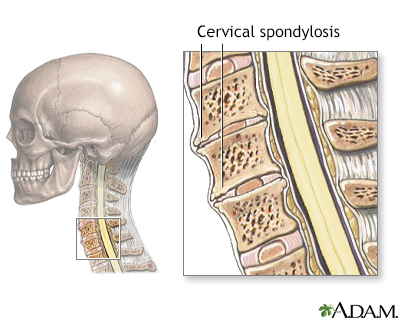 Cervical spondylosis - Illustration Thumbnail                      