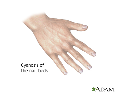 Cyanosis of the nail bed - Illustration Thumbnail                      