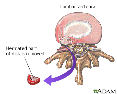 Herniated disk repair - Illustration Thumbnail                      
