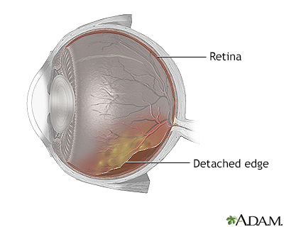 Detached retina - Illustration Thumbnail                      