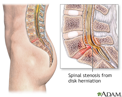 Spinal stenosis - Illustration Thumbnail                      