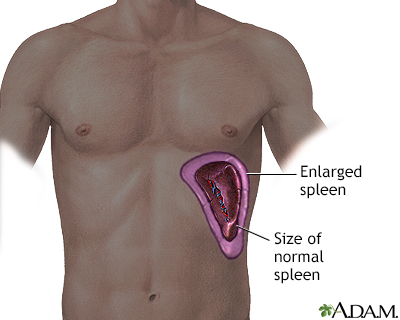 Enlarged spleen - Illustration Thumbnail                      