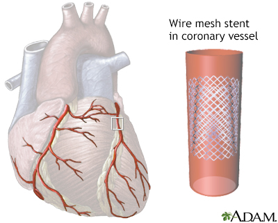Coronary artery stent - Illustration Thumbnail                      