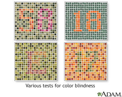 Color blindness tests - Illustration Thumbnail                      