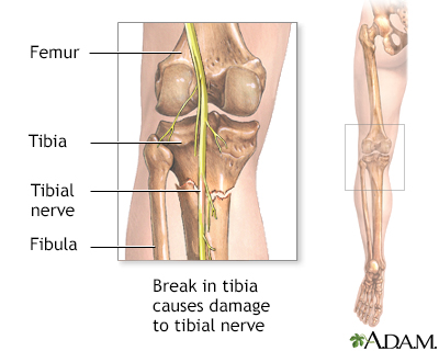 Tibial nerve - Illustration Thumbnail                      