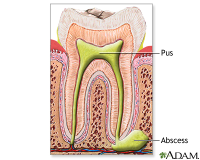Tooth abscess - Illustration Thumbnail                      