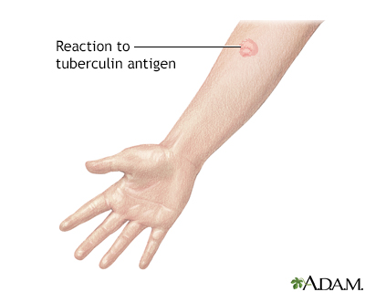 Tuberculin skin test - Illustration Thumbnail                      