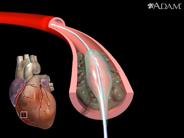 Balloon angioplasty - short segment