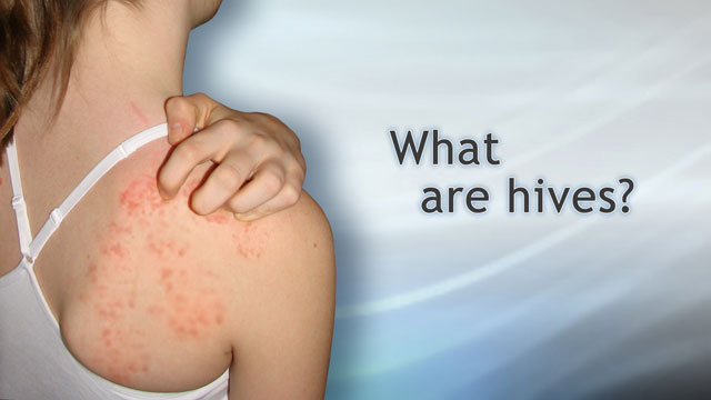 What are hives?