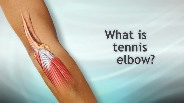 What is tennis elbow?