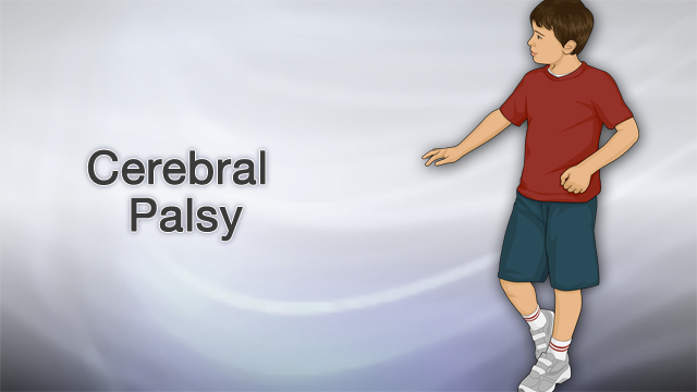 Cerebral palsy