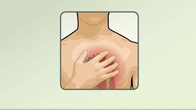 Cardiac arrhythmia: Heart palpitations and other symptoms