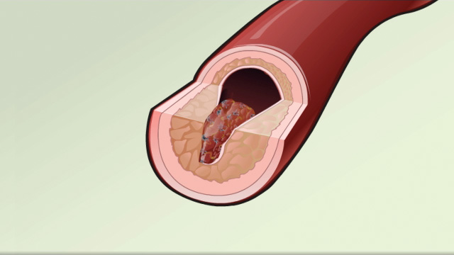 Cardiac and vascular disorders: Blood clots