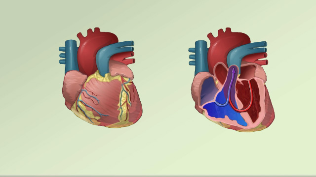 Congenital heart defects (CHD) overview