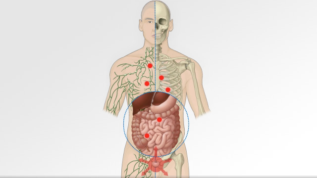 Carcinogenesis: How cancer spreads through the body